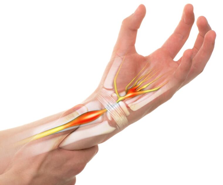 Wrist pain attributed to Carpal Tunnel Syndrome, depicted in an isolated image on a white background with transparent bones.