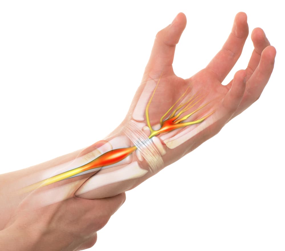 Wrist pain attributed to Carpal Tunnel Syndrome, depicted in an isolated image on a white background with transparent bones.